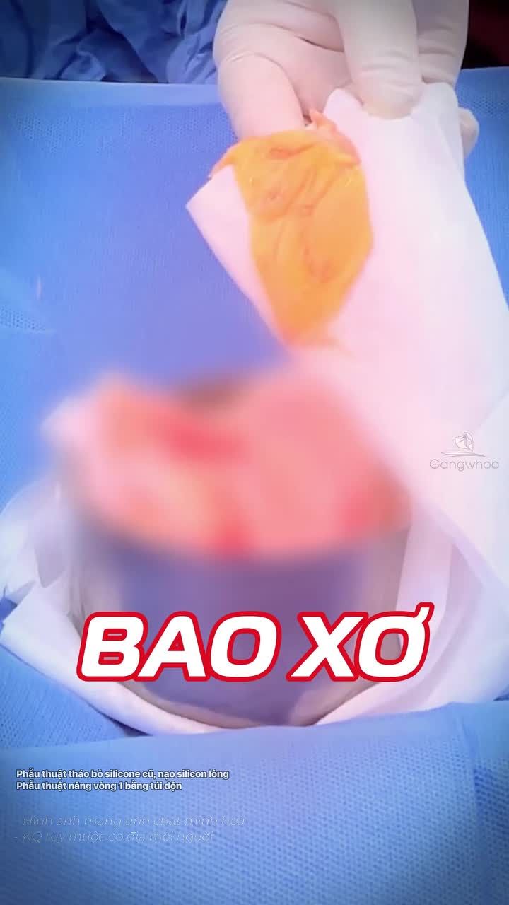 Sau hơn 20 năm đặt túi ngực, chị khách U60 tìm đến Gangwhoo trong tình trạng bao xơ và co thắt nghiêm trọng, khiến vòng 1 có nhiều thay đổi bất thường.