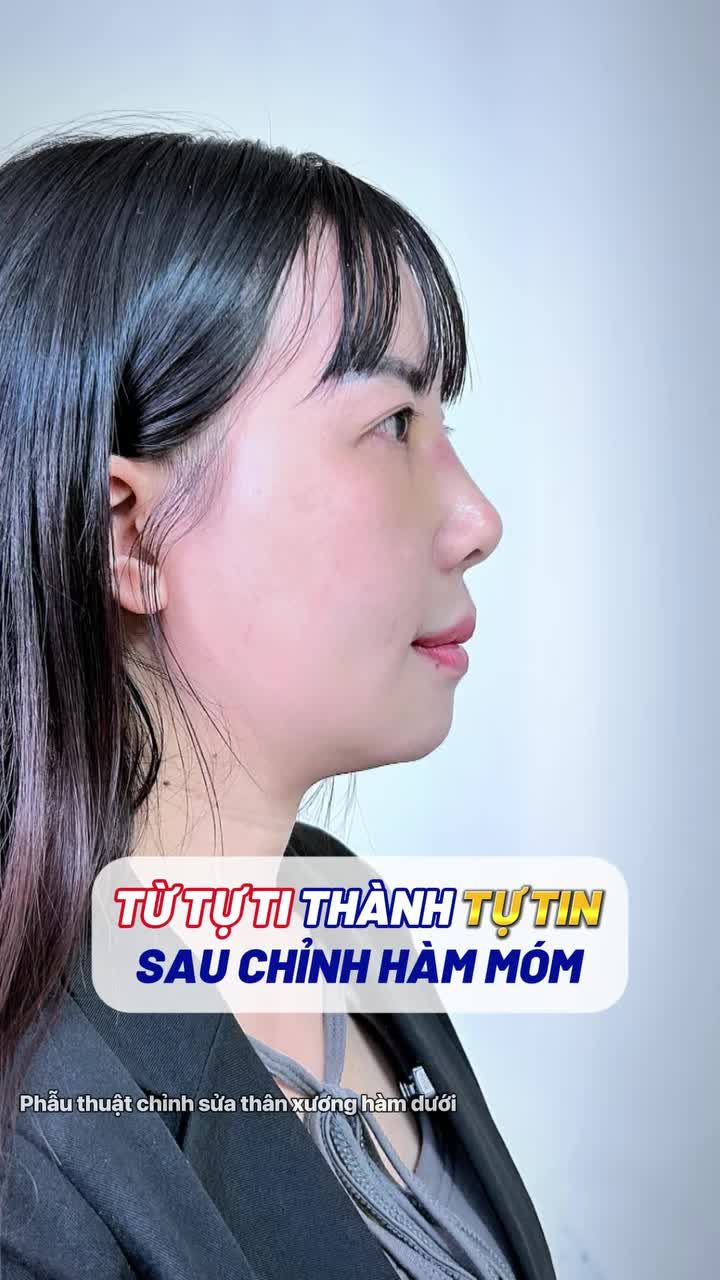 Từ tự ti đến tự tin sau 14 ngày chỉnh hàm móm của khách hàng Đài Loan