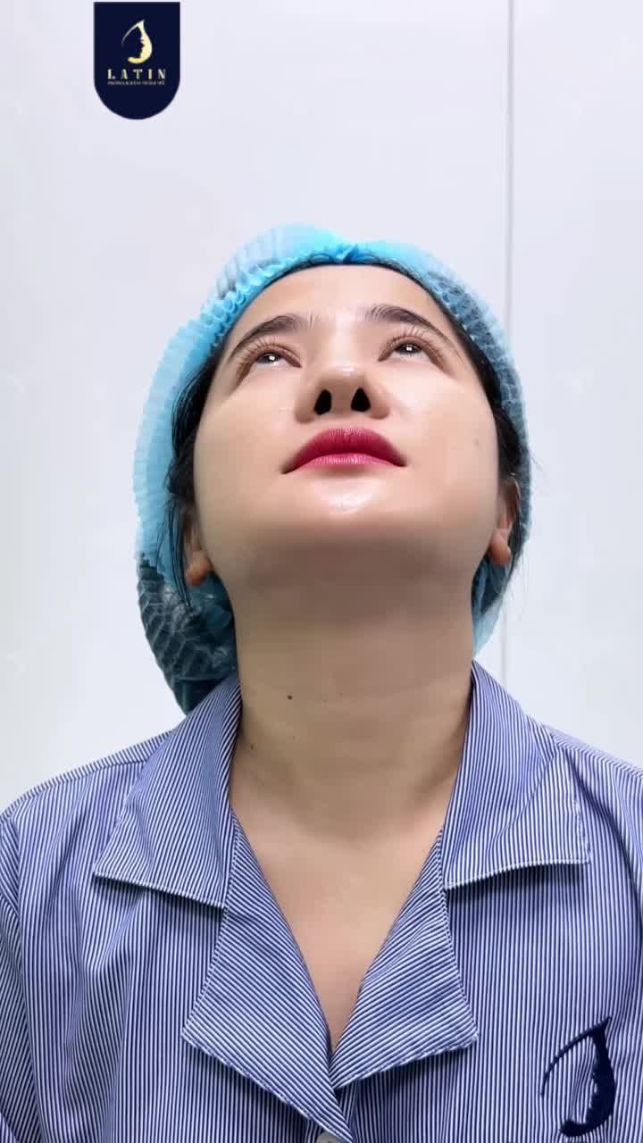 MŨI CẤU TRÚC 10 NGÀY – TẠM BIỆT XƯƠNG MŨI BÈ