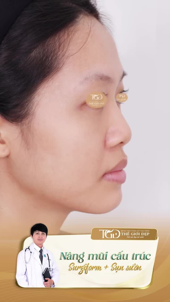 Kết quả sau 2 tháng hoàn thiện dáng mũi cho 2 quý Cô bằng giải pháp Nâng mũi cấu trúc sụn tự thân thanh surgiform