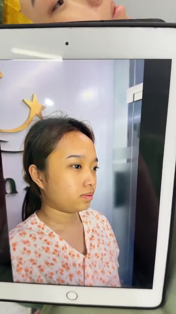 TRẢ KẾT QUẢ NÂNG MŨI NGAY SAU PHẪU THUẬT