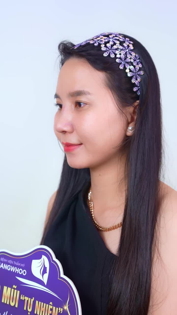 TÁI KHÁM HẬU PHẪU: HÀNH TRÌNH SỬA MŨI HỎNG SAU 8 NĂM – LẤY LẠI TỰ TIN VÀ TỰ NHIÊN SAU 15 NGÀY!