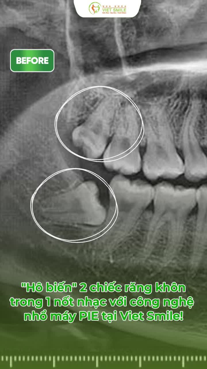 Chấm dứt những mệt mỏi mang tên “răng khôn” NHANH CHÓNG – NHẸ NHÀNG cùng Viet Smile với công nghệ nhổ máy tiên tiến hiện đại - Piezosurgery