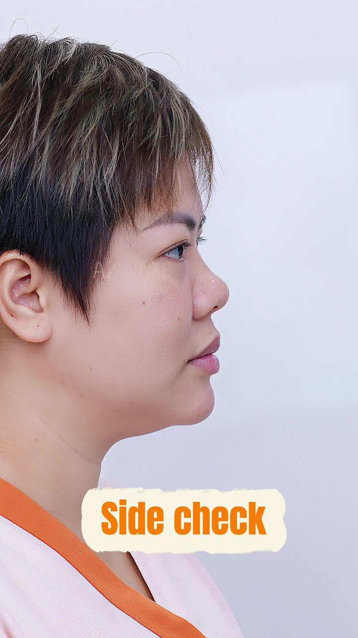 Từ Malaysia đến Viêt nam cho phẫu thuật chỉnh hình mũi - xem sự thay đổi của cô ấy sau 30 ngày.