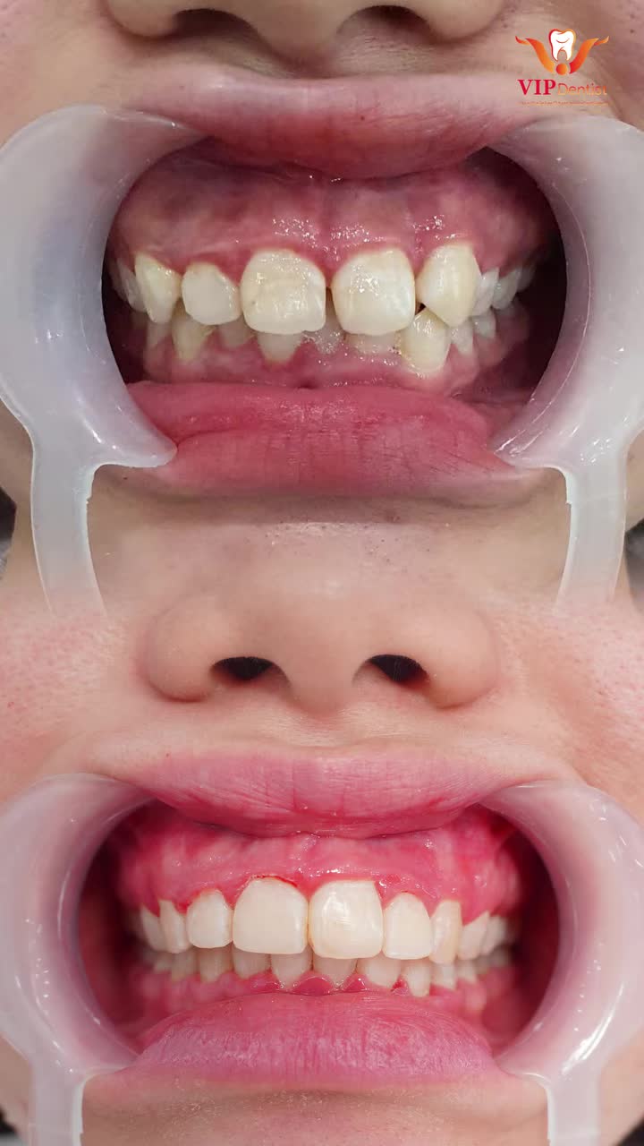LỆCH ĐƯỜNG CƯỜI DO RĂNG KHẤP KHỂNH!