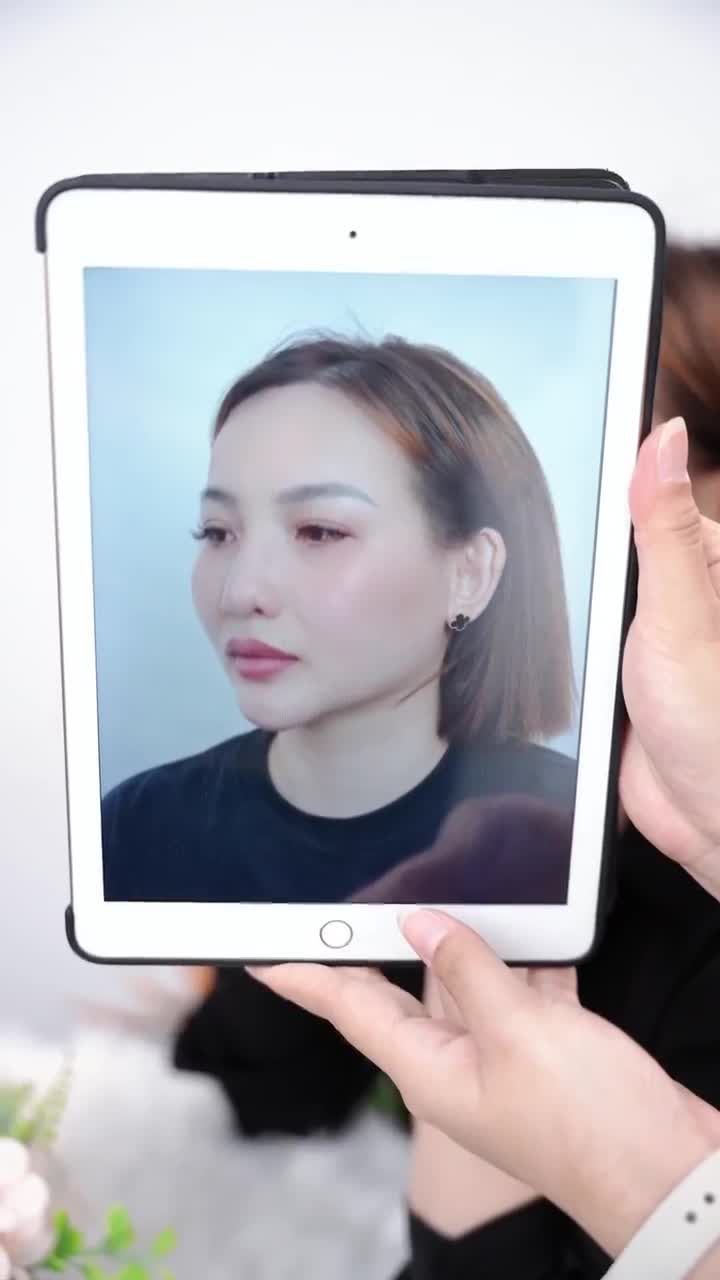 KẾT QUẢ SAU 14 NGÀY SỬA LẠI MŨI HỎNG KH: NGỌC GIÀU (SINGAPORE)