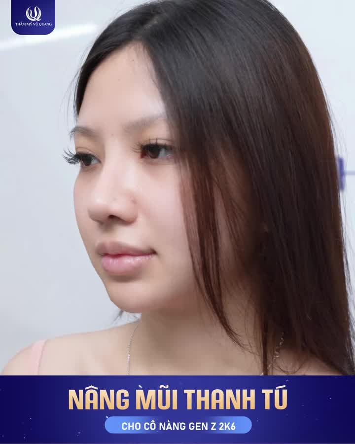 Sau thời gian dài ấp ủ, nhờ đôi bàn tay tài hoa của Bác sĩ Vũ Quang, mơ ước về một dáng mũi thanh tú của bạn ấy đã trở thành hiện thực.