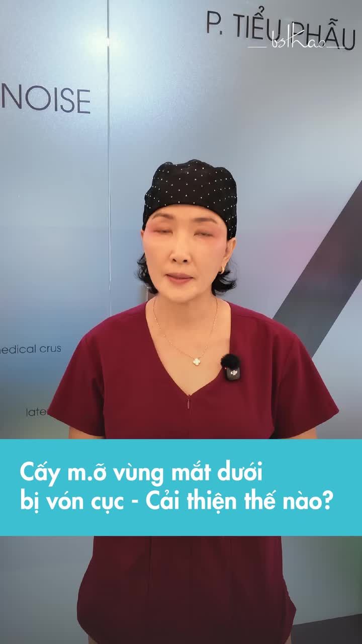 Cấy mỡ mắt dưới bị vón cục: Vì sao khó xử lý và phải làm gì?  Cấy mỡ mà bị vón thì chỉ cần "lấy cục mỡ ra" là xong? KHÔNG HỀ!