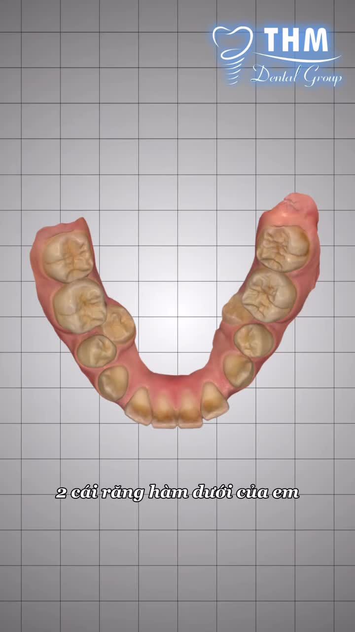 Implant không phải "cắm xong là có răng".