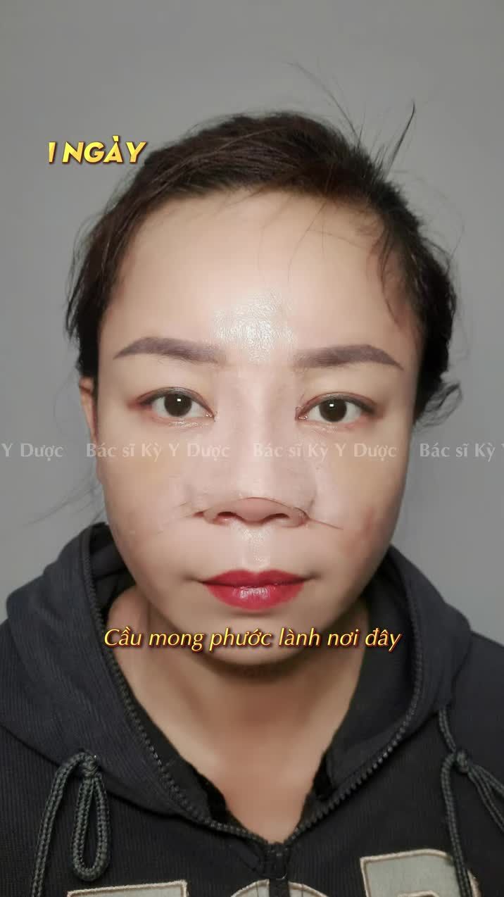 Mê làm đẹp từ lâu, ấp ủ một dáng mũi mới đã lâu… nhưng đến hôm nay mới thật sự có cơ hội thực hiện điều mình mong muốn.