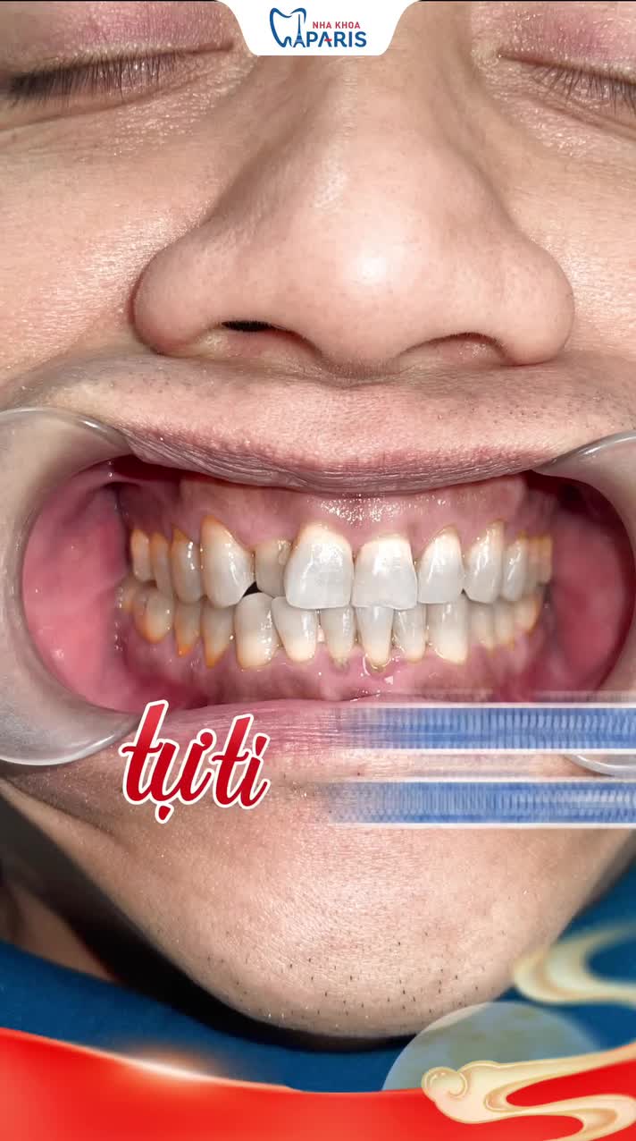 U40 RĂNG MÒN MEN, NGẢ VÀNG – LỘT XÁC RẠNG RỠ VỚI RĂNG SỨ CHUẨN PHÁP!