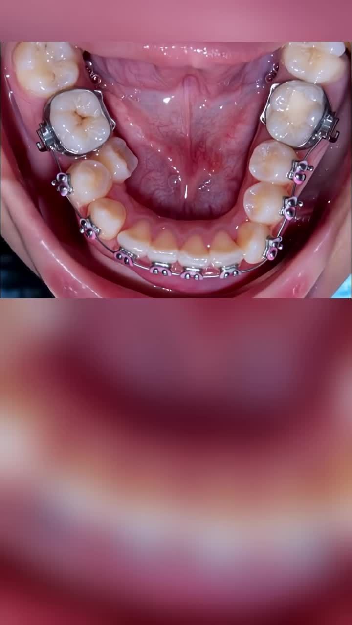 Tạo khoảng để răng về đúng vị trí