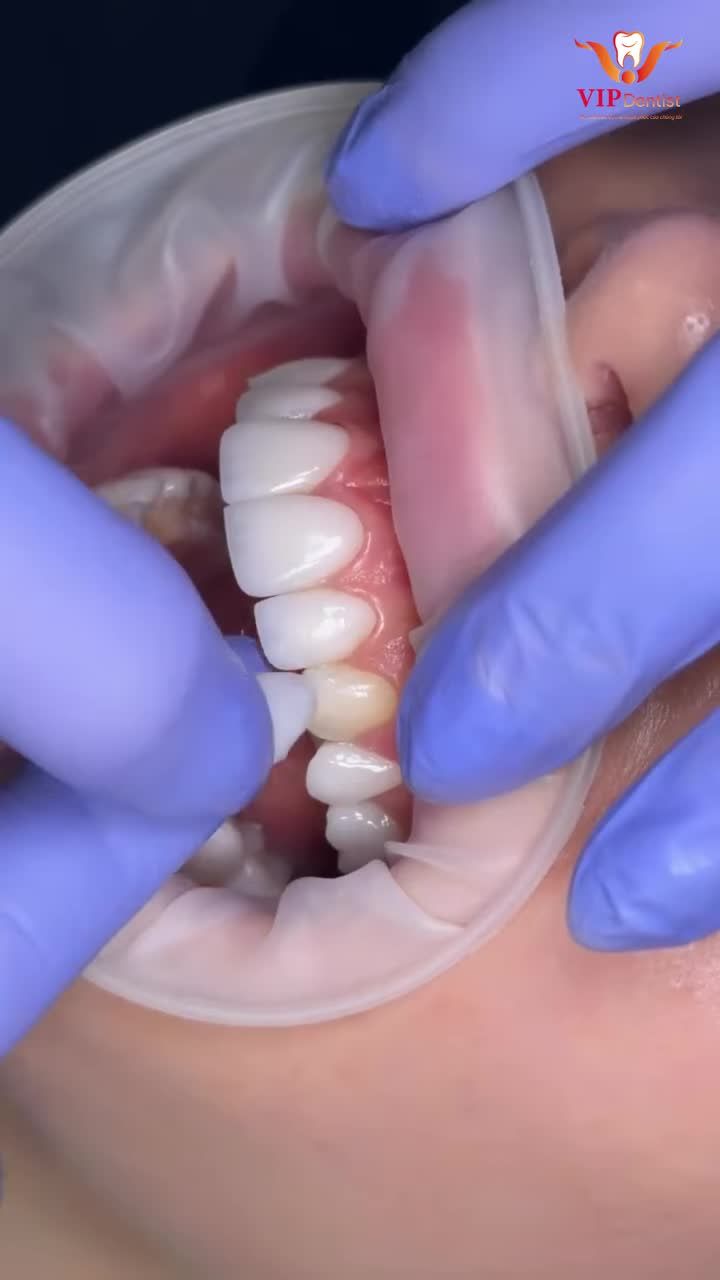 SỞ HỮU NỤ CƯỜI TỰ NHIÊN – KHÔNG CẦN MÀI RĂNG VỚI VENEER SIÊU MỎNG