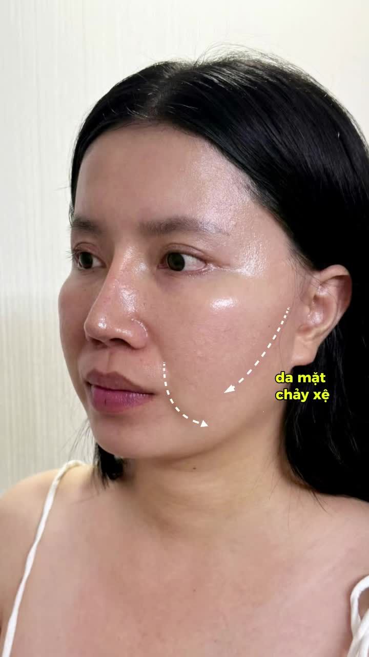 CHẤM DỨT NỖI LO SẸO LỒI SAU KHI CĂNG DA LỖI!