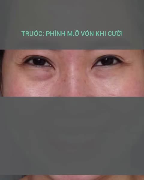 KQ sau 7 ngày xử lý m.ỡ vón cục vùng mắt dưới, hoàn chỉnh độ phẳng mí dưới bằng cấy mỡ, filler MD Codes kết hợp Profhilo