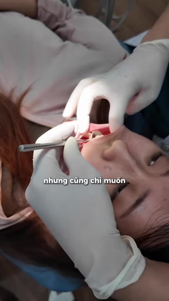 Niềng răng bao lâu thì xong?