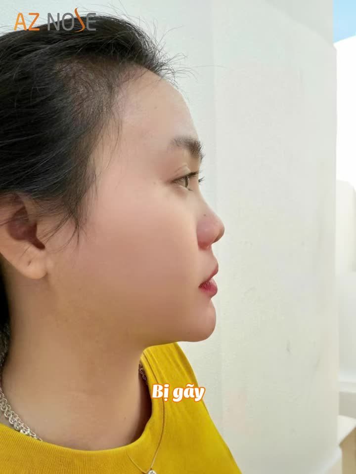 "Mũi không có sóng, bị gãy" được cải thiện ra sao sau 1 tháng nâng mũi cấu trúc?