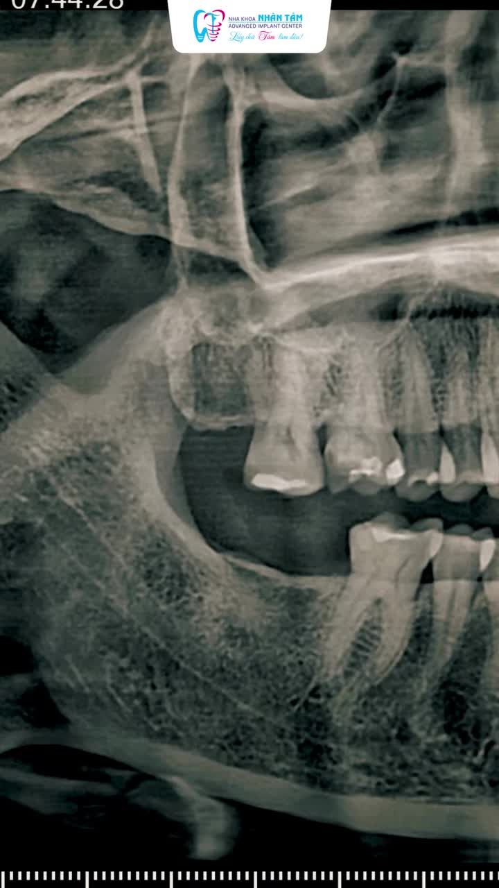 10 năm trì hoãn vì sợ đau – và đây là điều chị Dung bất ngờ sau khi trồng Implant