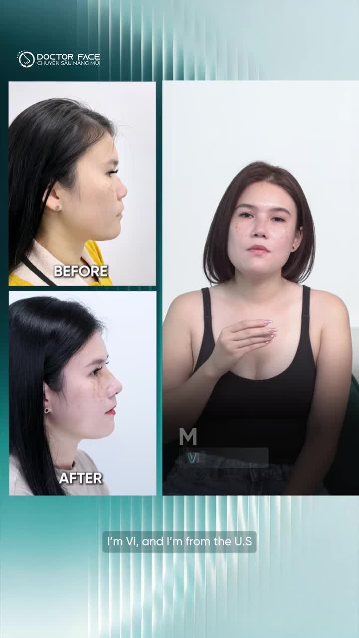 Xem thêm 3447 video Nâng Mũi của bác sĩ Bs Trần Phương