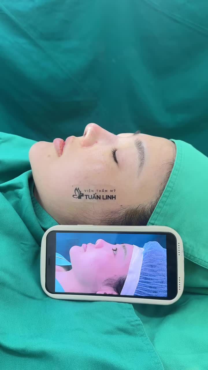 Mũi cấu trúc rút chỉ sau phẫu thuật
