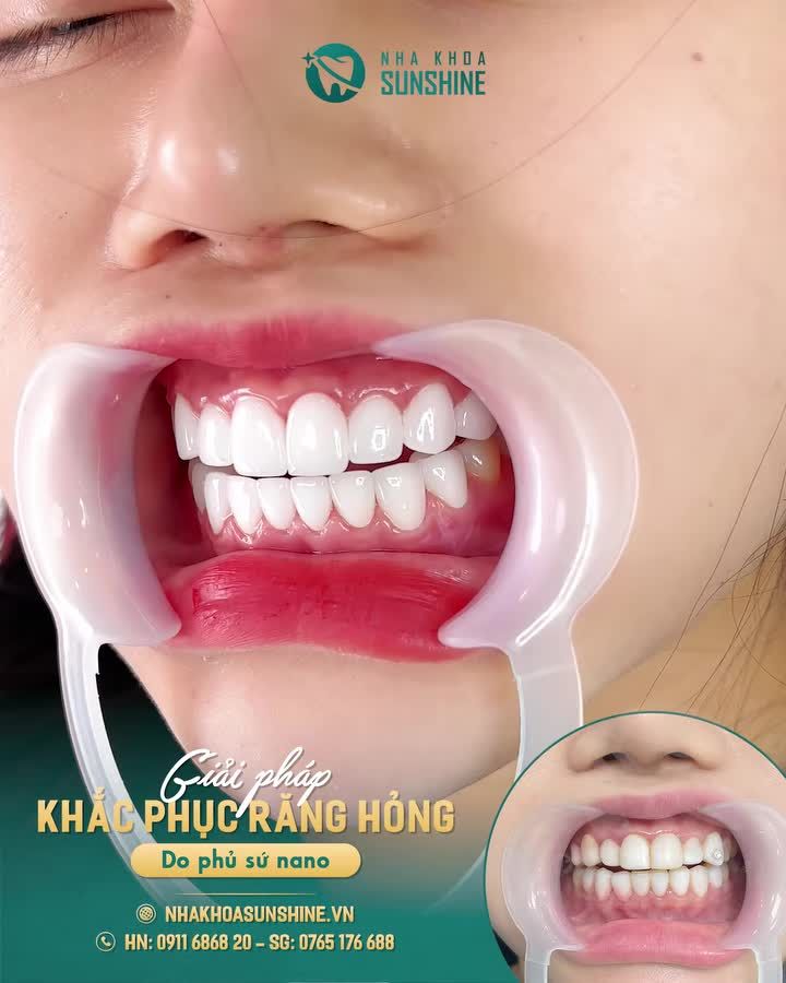 BẠN ĐANG MỖI NGÀY ÂM THẦM CHỊU ĐỨNG NỖI ĐAU TỪ "PHỦ SỨ NANO"?