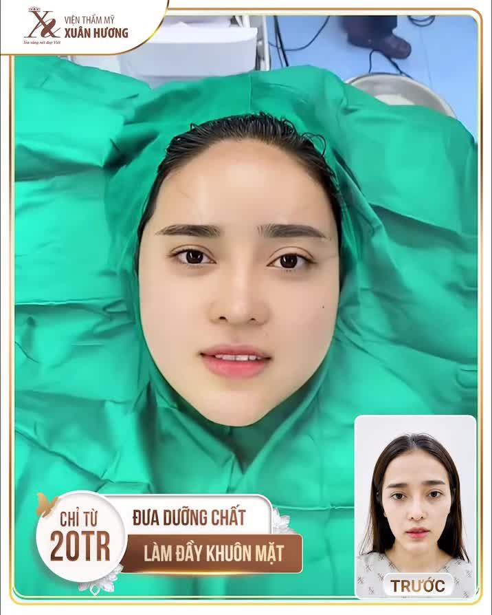 CHỈ TỪ 20 TRIỆU - ĐƯA DƯỠNG CHẤT LÀM ĐẦY GIÚP GƯƠNG MẶT ĐẸP CHUẨN Á ĐÔNG