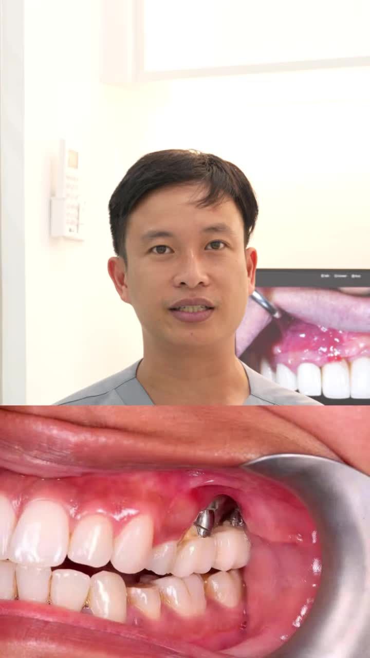 ĐỪNG ĐỢI IMPLANT LUNG LAY MỚI ĐIỀU TRỊ VIÊM — LÚC ĐÓ CÓ THỂ ĐÃ QUÁ MUỘN.