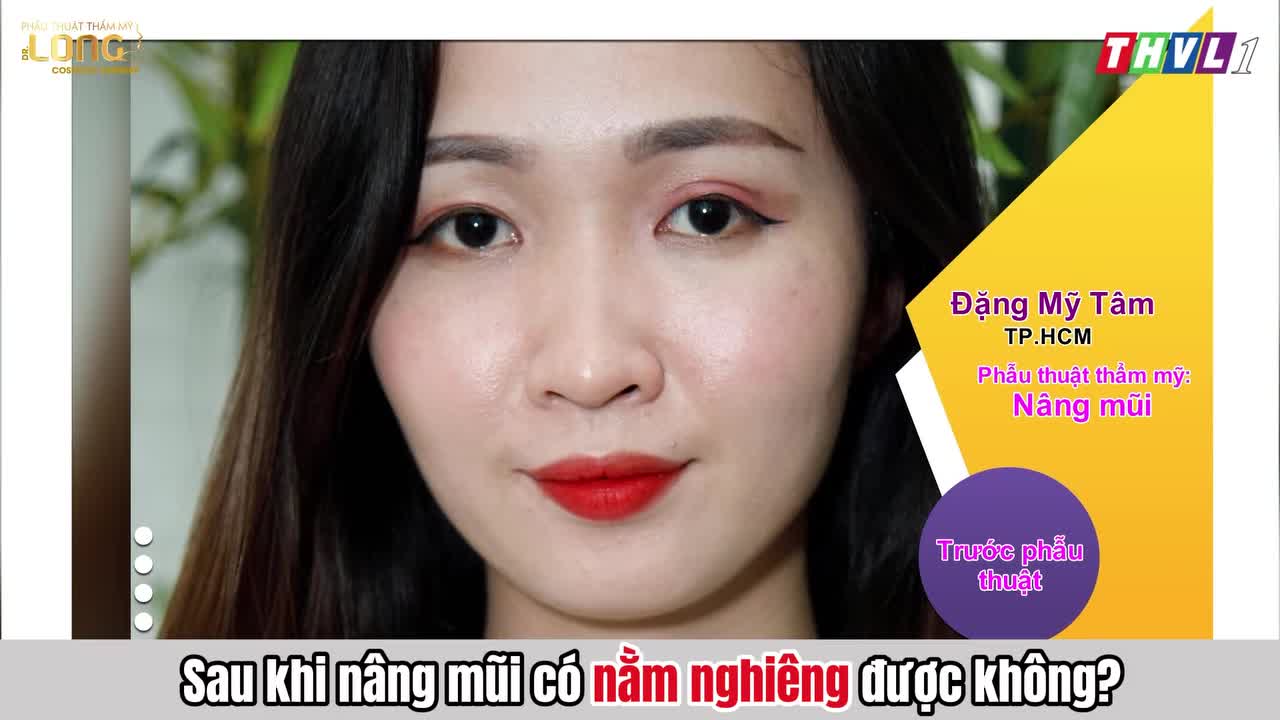 Sợ mũi bị xiêu quẹo chỉ vì lỡ... nằm nghiêng sau khi nâng?
