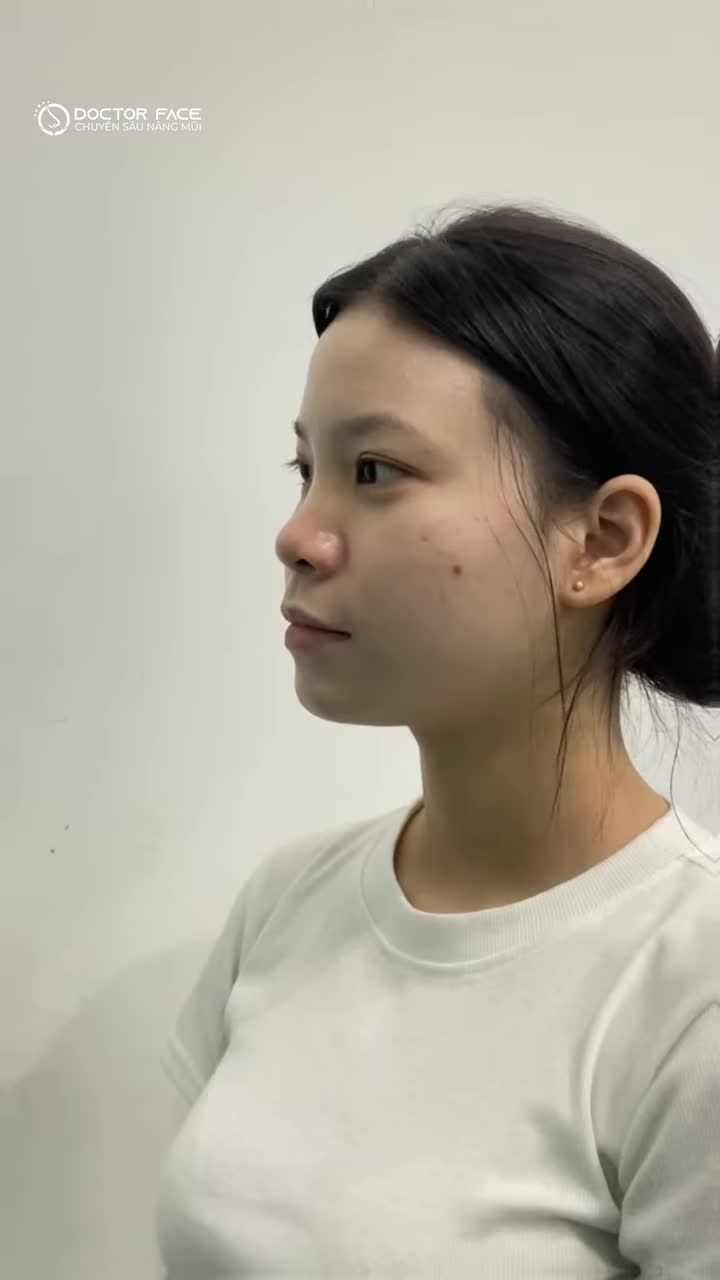 2 NĂM SAU NÂNG MŨI TẠI DR FACE Chỉ thay đổi mỗi dáng mũi thôi mà nhìn cô ấy khác hẳn luôn
