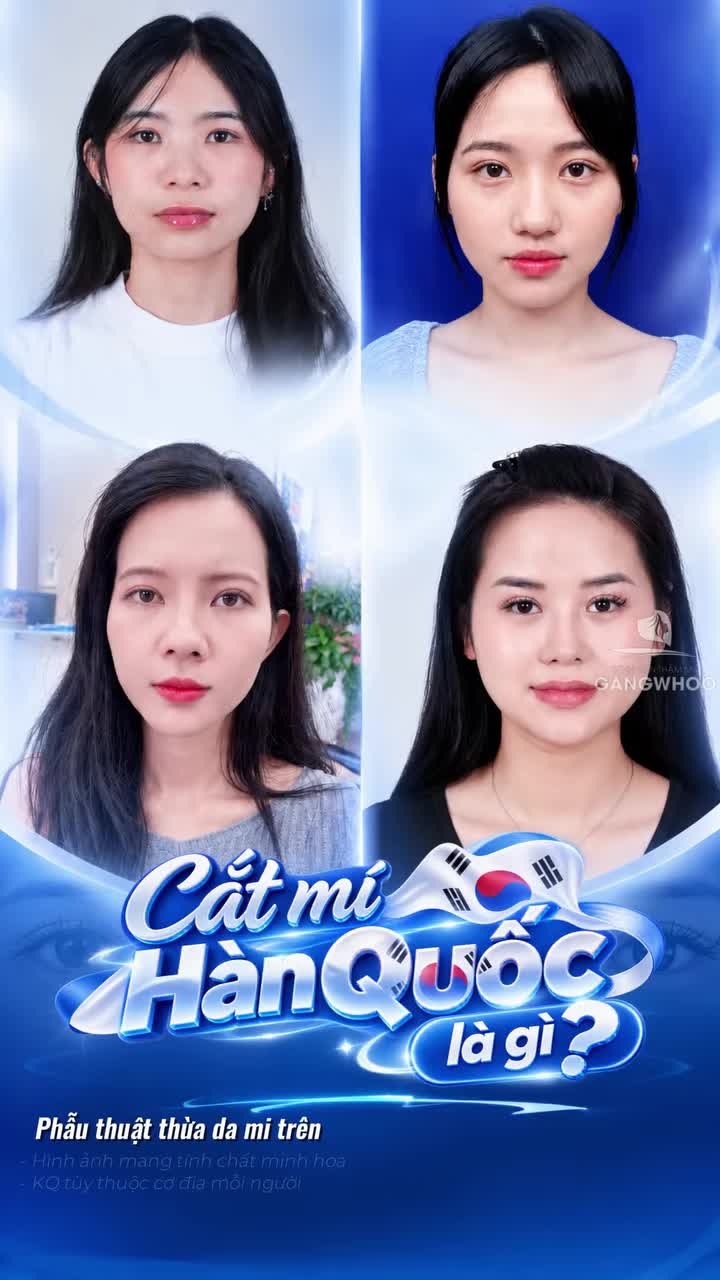 Cắt mí Hàn Quốc là gi mà được nhiều khách hàng yêu thích lựa chọn thực hiện