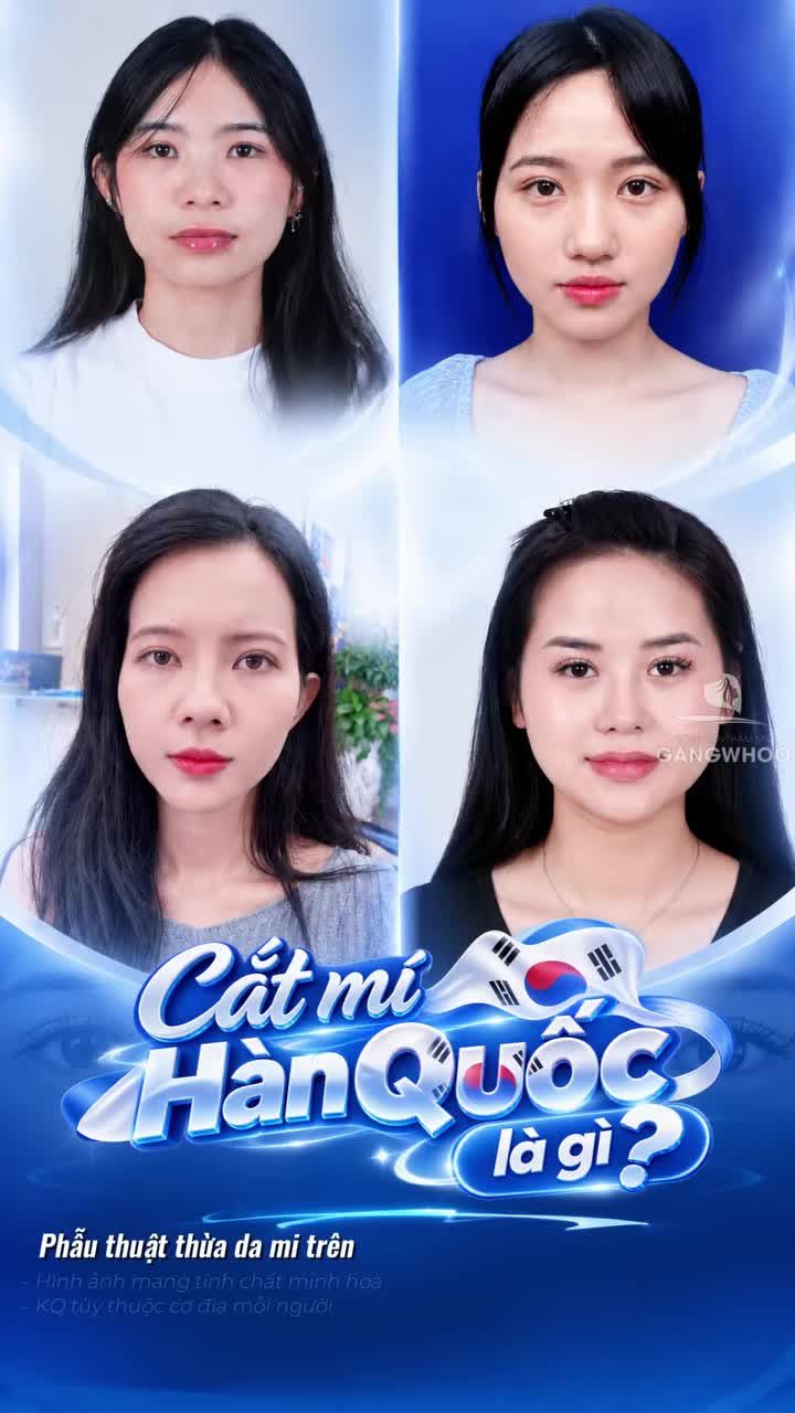 Cắt mí Hàn Quốc là gi mà được nhiều khách hàng yêu thích lựa chọn thực hiện
