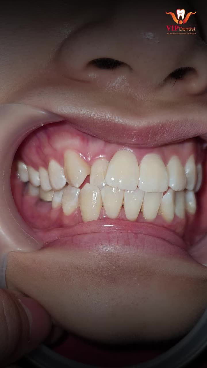 THAY ĐỔI HÀM RĂNG - KHUÔN MẶT BỪNG SÁNG