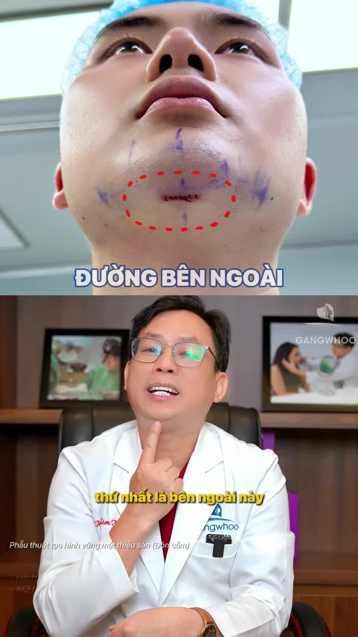 Độn cằm bao lâu thì được đánh răng?
