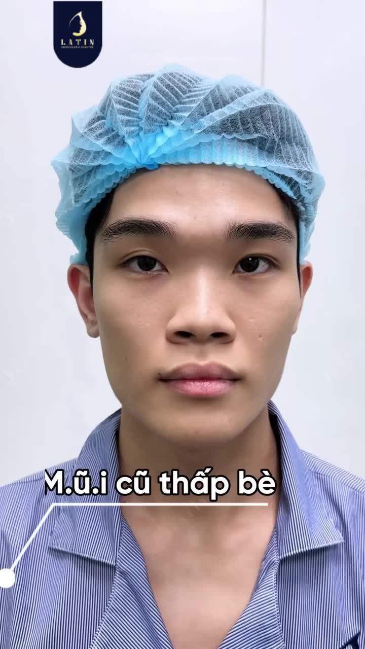 20 NGÀY TÁI KHÁM:  DÁNG MŨI NAM SURGIFORM GOM FORM RA SAO?