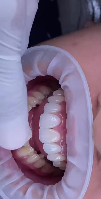 Bạn có đang nhìn chằm chằm vào màn hình và tự hỏi: "Sao răng sứ mà lại trông thật đến thế này?"