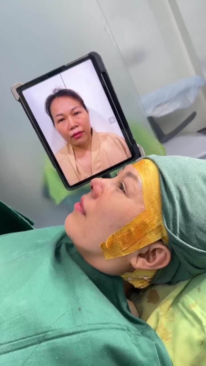 KẾT QUẢ NÂNG MŨI CẤU TRÚC DR.HOẠT SAU 60 PHÚT