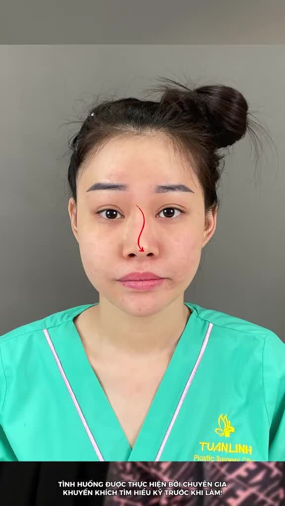 CHIẾC MŨI SỬA NHIỀU LẦN