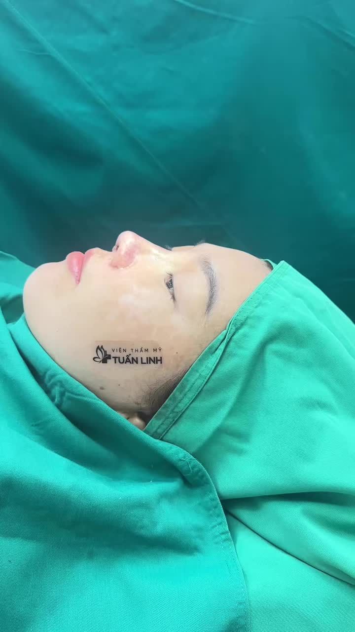 NÂNG MŨI CẤU TRÚC - CÔ BÉ SINH VIÊN THĂNG HẠNG NHAN SẮC CHỈ SAU 90 PHÚT