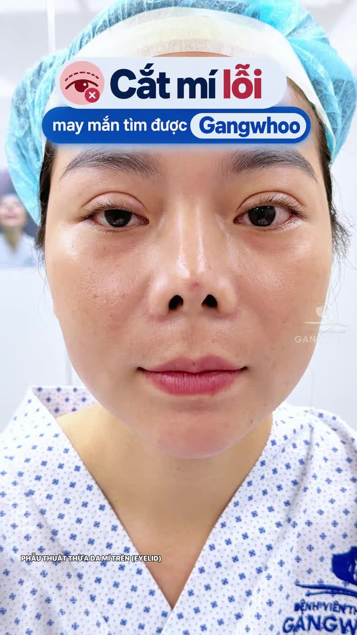 Từng cắt mí lỗi nhưng may mắn tìm được Gangwhoo và sở hữu diện mạo hài hòa hơn