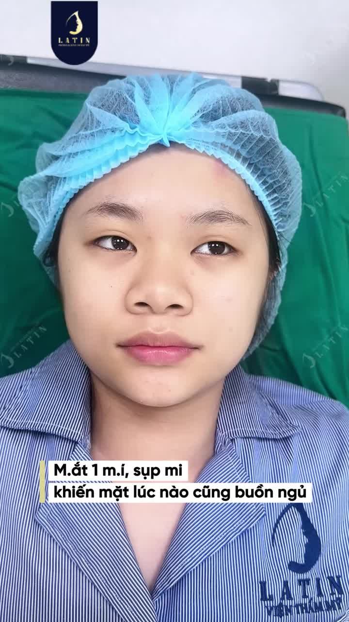 MẮT LUÔN BUỒN NGỦ MÍ 4D + CHỈNH NHƯỢC CƠ BIẾN HÌNH RA SAO?