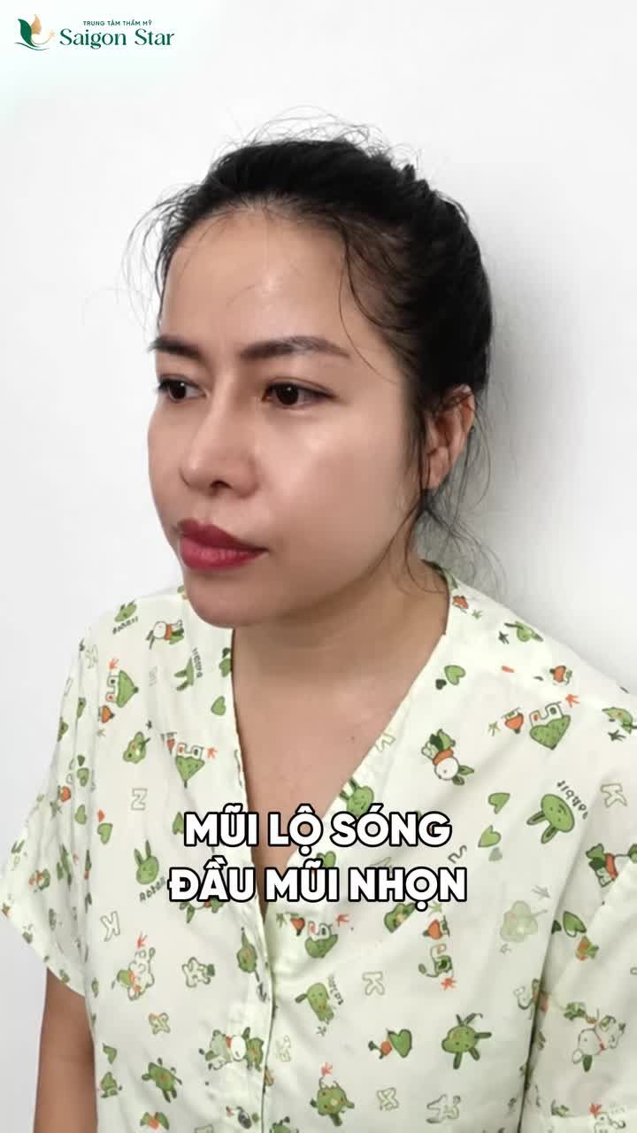 MŨI ĐÃ NÂNG NHIỀU LẦN - BIẾN CHỨNG NẶNG LIỆU CÓ SỬA LẠI ĐƯỢC KHÔNG??