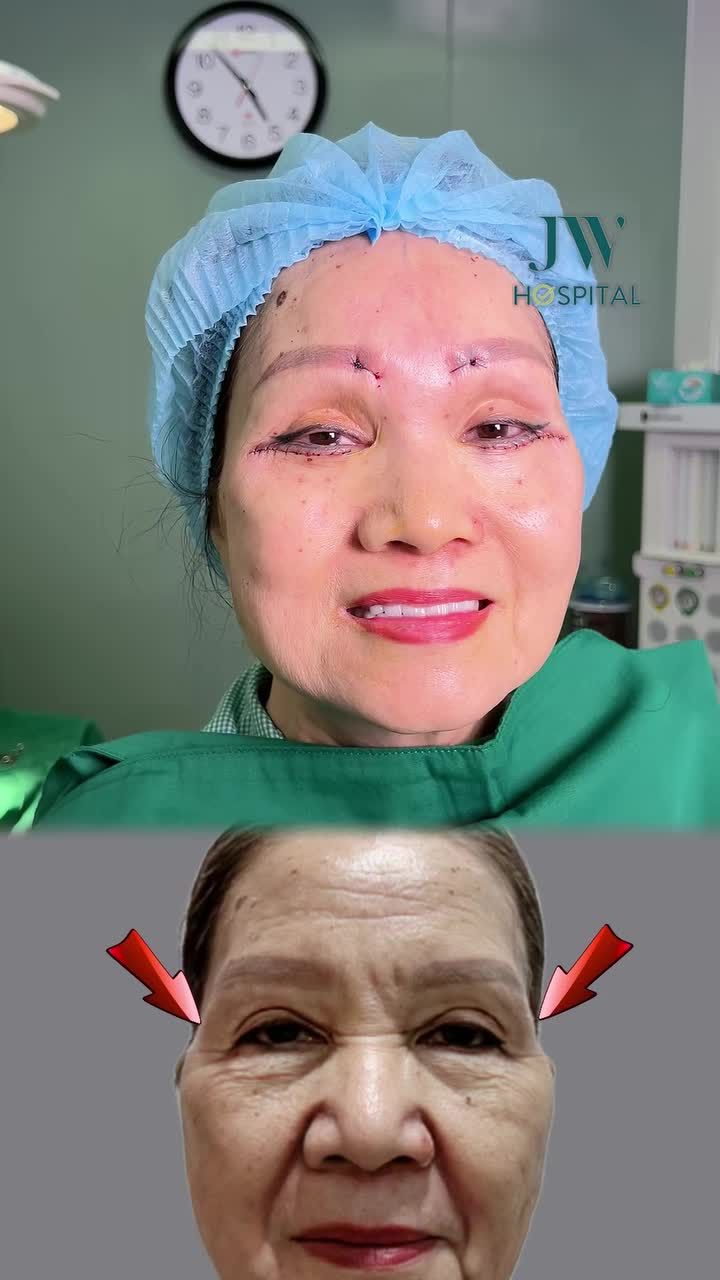 BÁC SĨ TÚ DUNG XỬ LÝ NHĂN CAU MÀY, VẾT CHÂN CHIM CHO U70 VIỆT KIỀU MỸ TRẺ 20 TUỔI NGOẠN MỤC