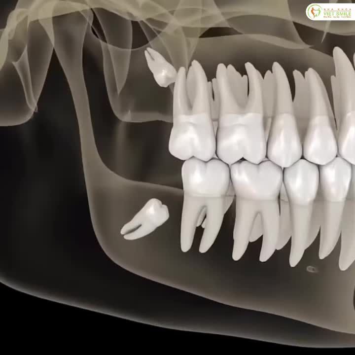 Mất ăn, mất ngủ vì răng khôn “hành hạ” → Trải nghiệm nhổ răng khôn nhẹ nhàng chỉ từ 599K/1 răng tại Viet Smile