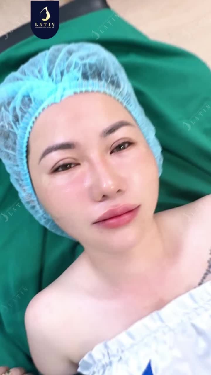 CẤY MƠ MÍ DƯỚI BÍ QUYẾT TRẺ OUT TUỔI CHO ĐÔI MẮ.T
