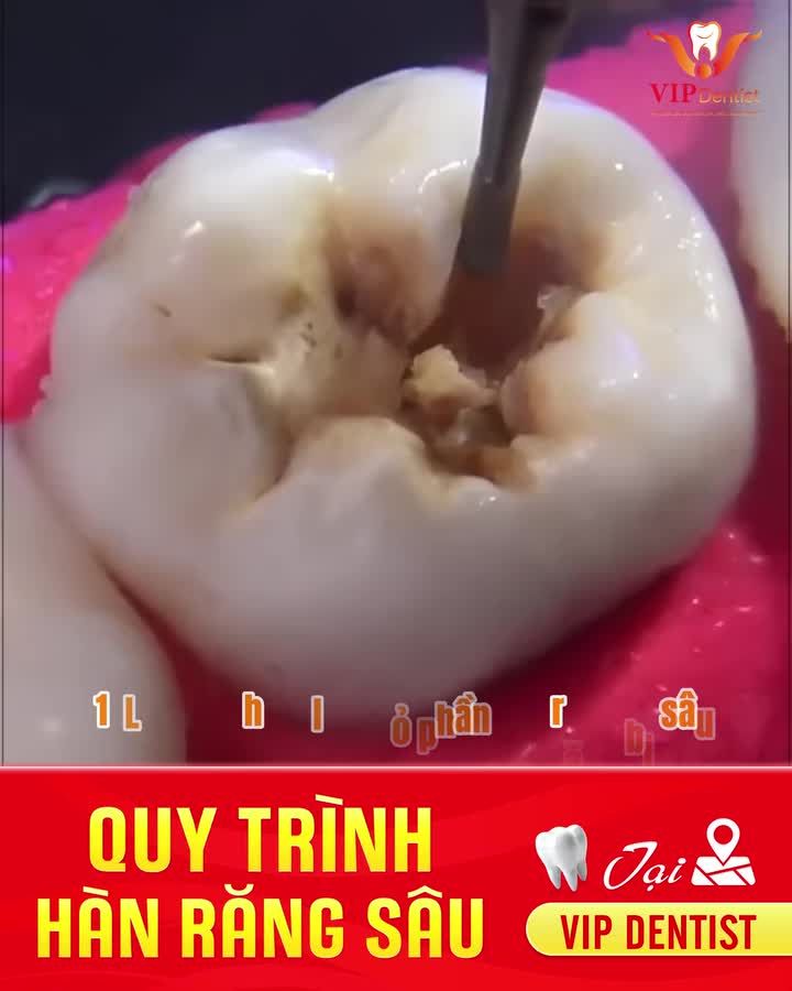 CHẶN ĐỨNG SÂU RĂNG – KHÔI PHỤC NỤ CƯỜI CHỈ TRONG 15 PHÚT TẠI VIP DENTIST!