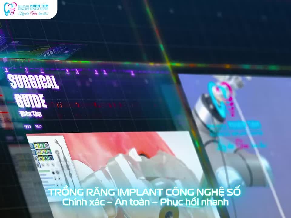 TỪ ĐỊNH VỊ ĐẾN ROBOT: CÔNG NGHỆ ĐANG THAY ĐỔI CÁCH ĐIỀU TRỊ IMPLANT