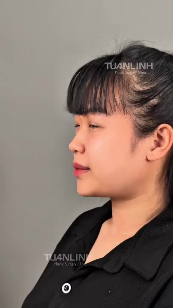 NÂNG MŨI CẤU TRÚC DÁNG THIẾT KẾ - THAY ĐỔI NHỎ, THAY ĐỔI CẢ KHUÔN MẶT