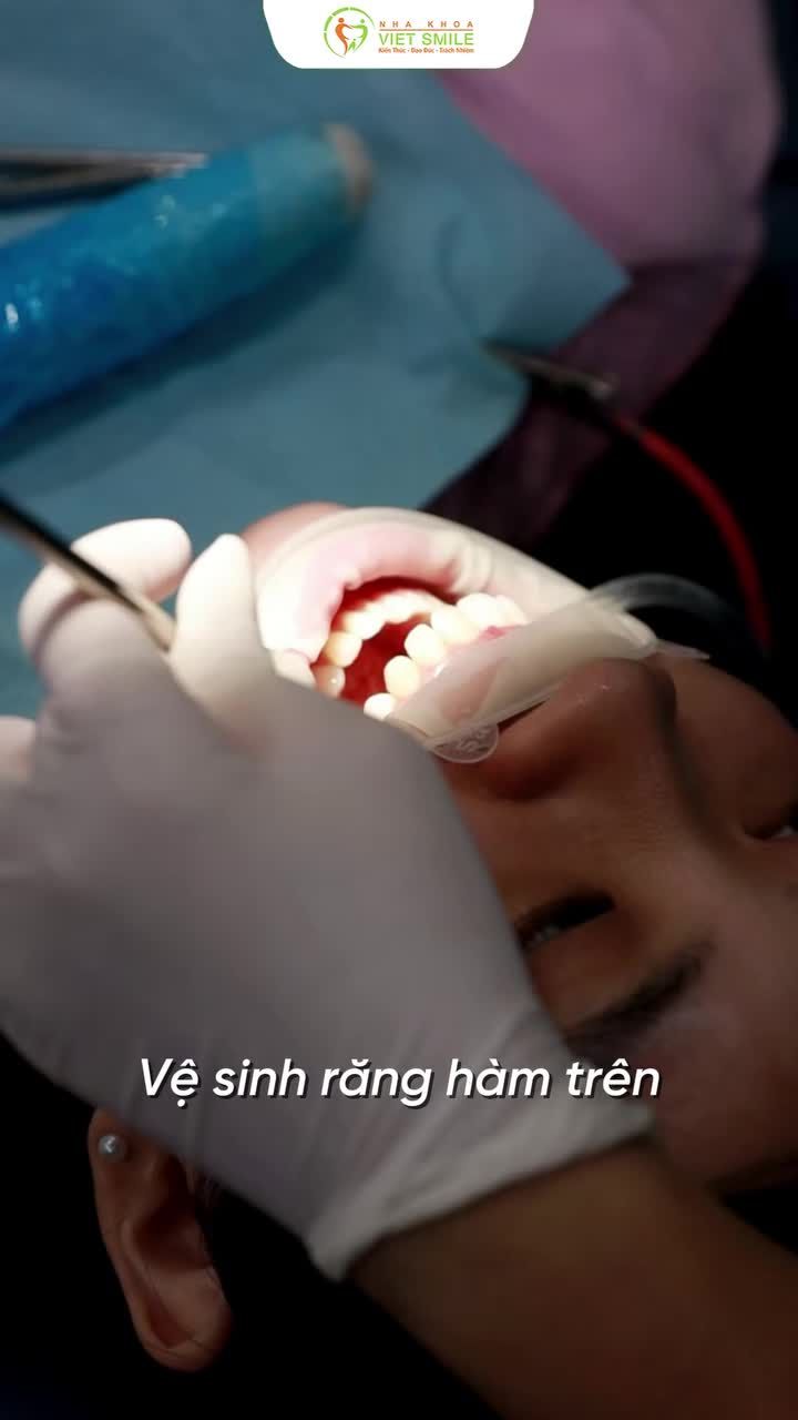Gắn mắc cài bắt đầu hành trình niềng răng cùng Viet Smile