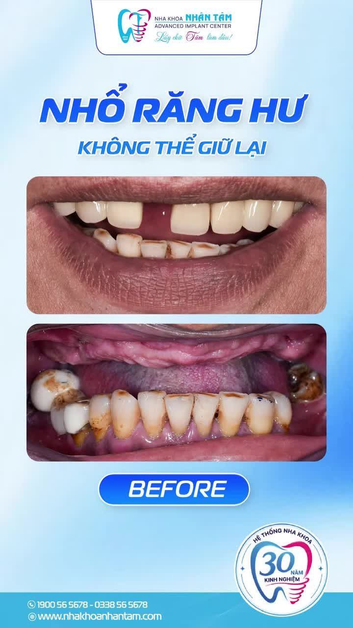 “TỪ KHI MẤT RĂNG, MỘT BỮA ĂN NGON CŨNG TRỞ NÊN XA XỈ”