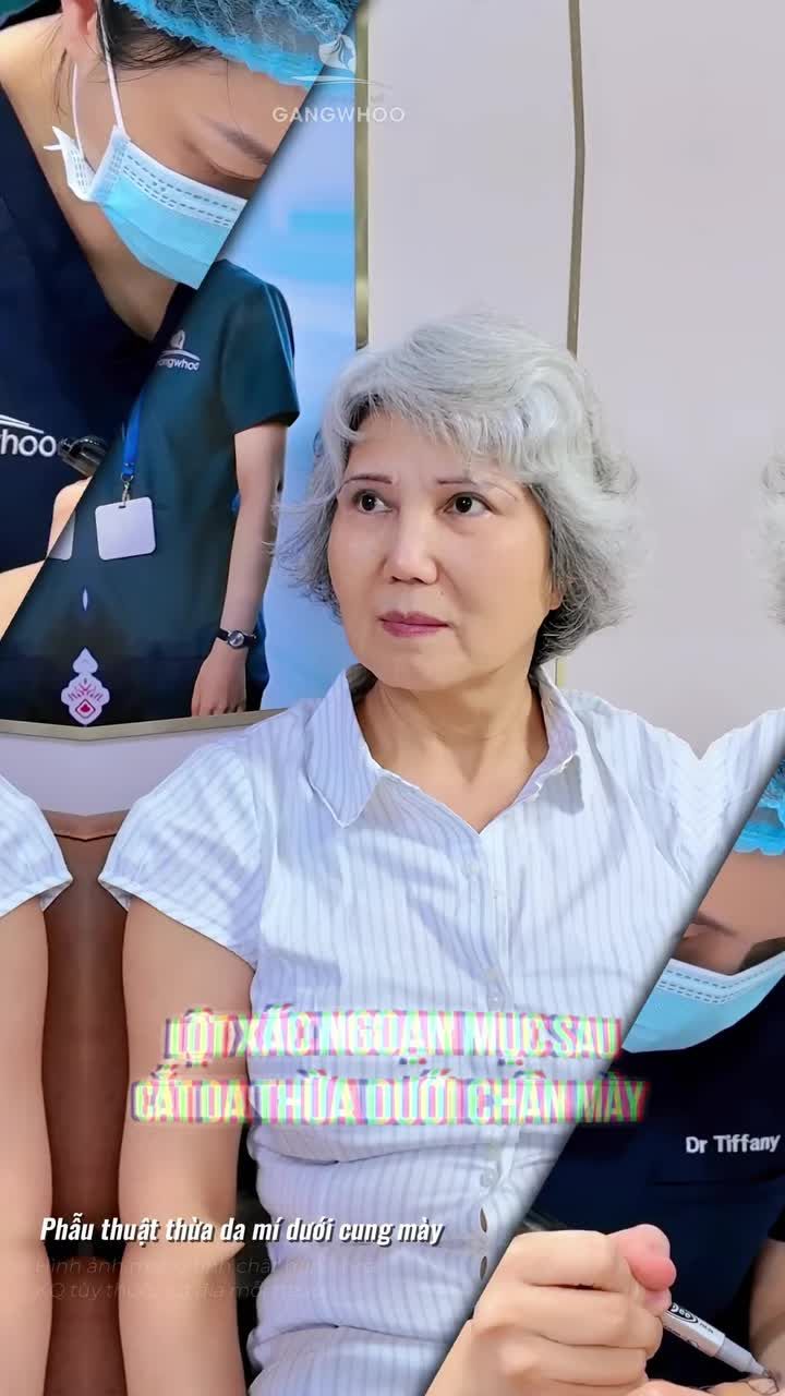 Khắc phục khuyết điểm da mí chùng nhão, sụp che khuất tầm nhìn sau cắt da thừa dưới đường chân mày